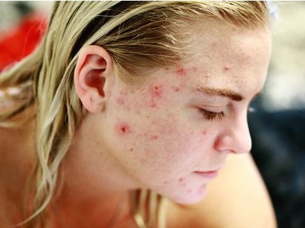 traitements contre l'acné