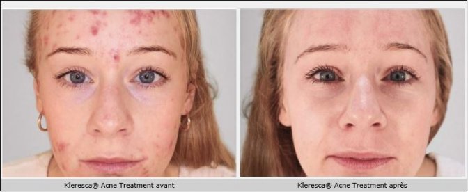 , Kleresca : traitement contre l’acné, Centre Laser Paris Sorbonne : Soins Esthétiques &amp; Dermatologie