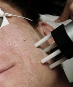 , Acne scars treatment, Centre Laser Paris Sorbonne : Soins Esthétiques &amp; Dermatologie