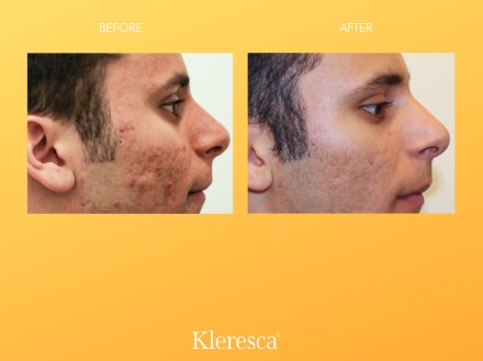 , Découvrez Kleresca ! Un traitement efficace contre l’acné, Centre Laser Paris Sorbonne : Soins Esthétiques &amp; Dermatologie