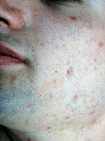 Traitement laser de l’acné