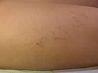 varicosités des jambes